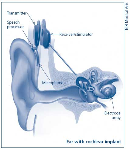 Ear with cochlear implant.