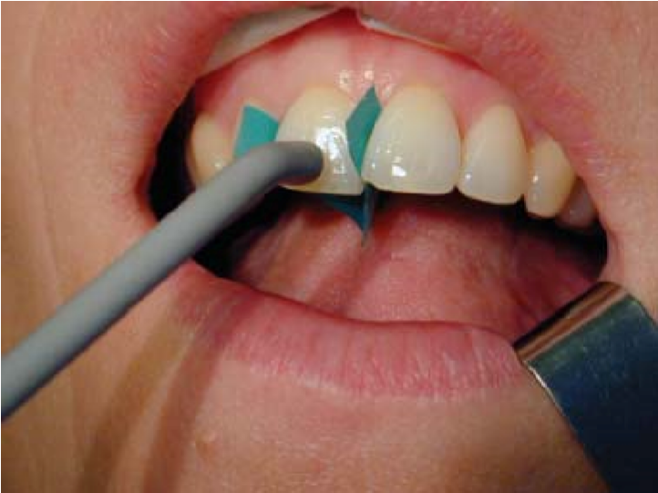 Electric pulp testing of an upper right central incisor isolated from adjacent teeth by rubber dam strips
