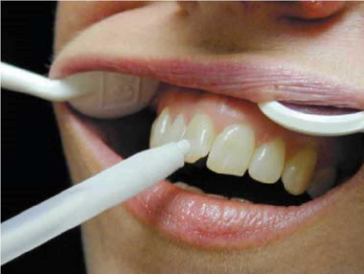 Pulp testing of a tooth using ice‐sticks