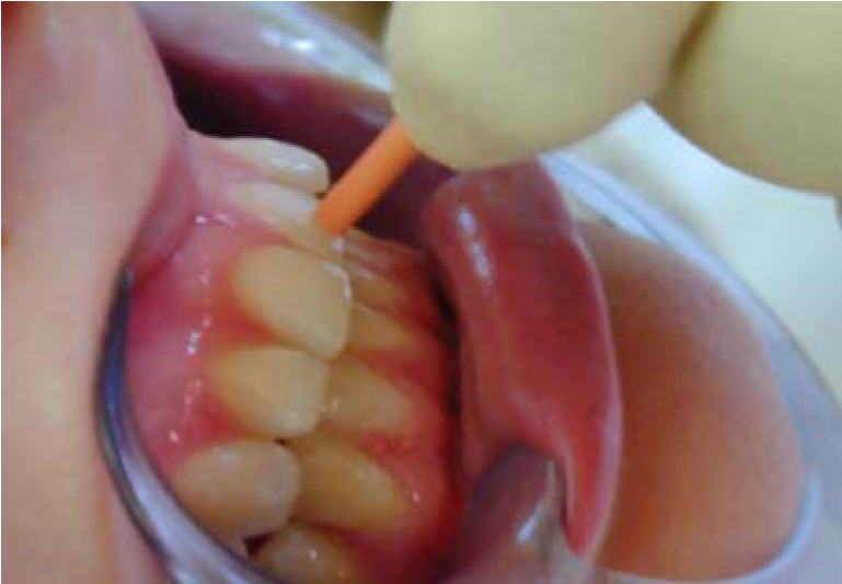 Pulp testing of a tooth using heated gutta-percha