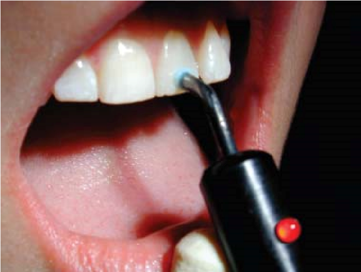 Pulp testing of a tooth using an electric pulp tester