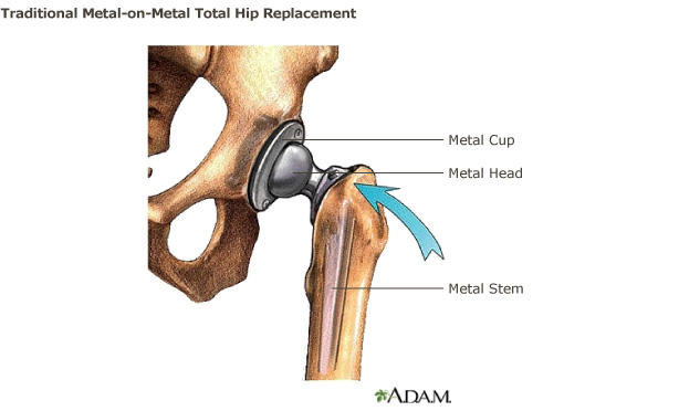 Traditional metal-on-metal total hip replacement