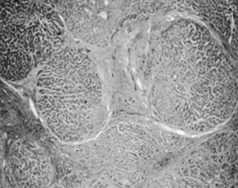 Liver biopsy showing presence of cirrhosis