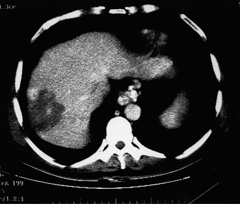 CT scan demonstrating mass in right hepatic lobe