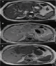 MRI HCC (Ghanaati et al 2012)
