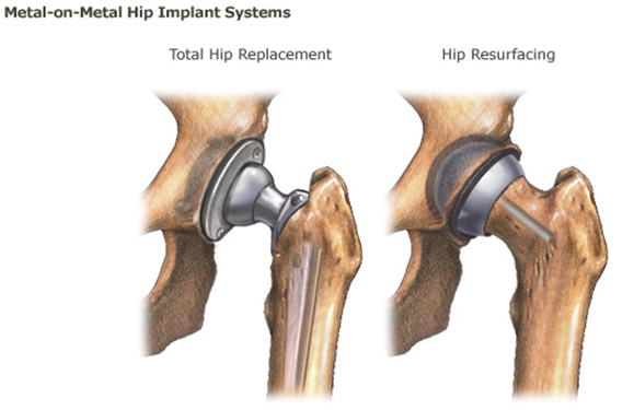 Metal-on-metal hip implant systems