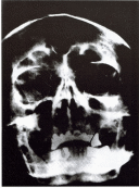 An X-ray of Hitler’s skull
