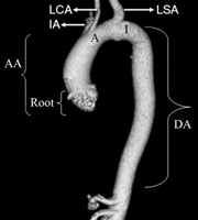 Radiographic illustration of a normal thoracic aorta