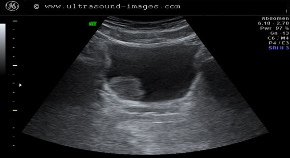 An ultrasound image of a TCC in 2 different anatomical areas of the urinary system