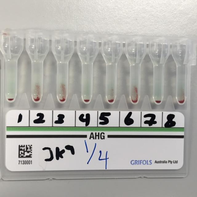 Anti-Jka antibodies Gel Card test
