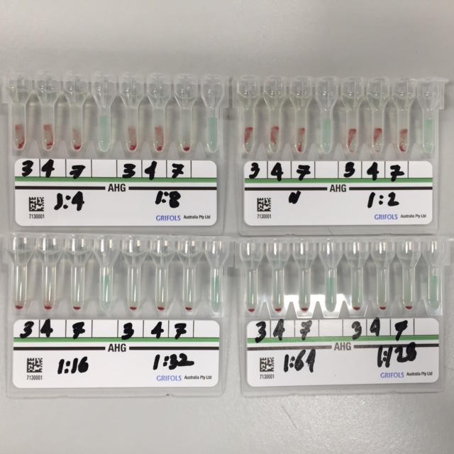  Serial dilution of the Gel Card assay.