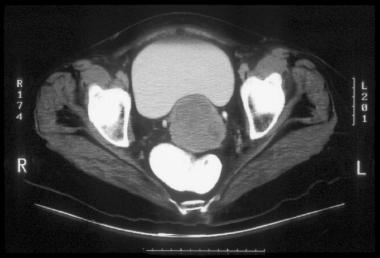 A CT of carcinoma in the cervix (cancer stage IB).