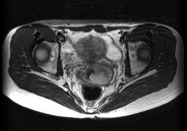 MRI image showing parametrial and anterior fornix invasion (Cancer stage IIB).