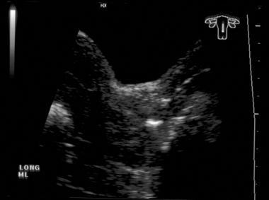 Sonogram of the enlarged cervix with heterogeneous echogenicity (Cancer stage IIB).