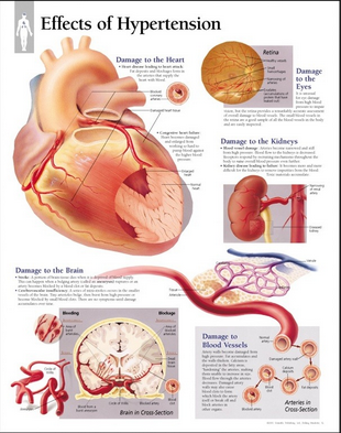 Impacts of Hypertension.