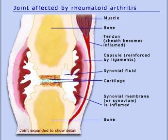 Joint affected by rheumatoid arthritis