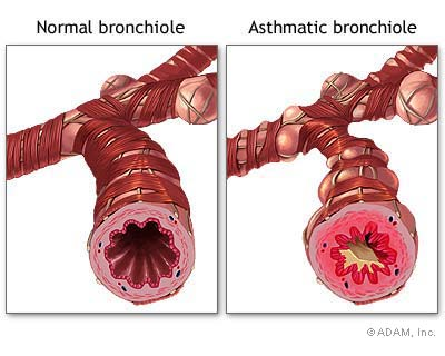 the constriction of asthmatic airways as compared to the normal airways 