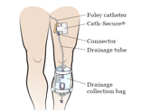 Foley Urinary Catheters