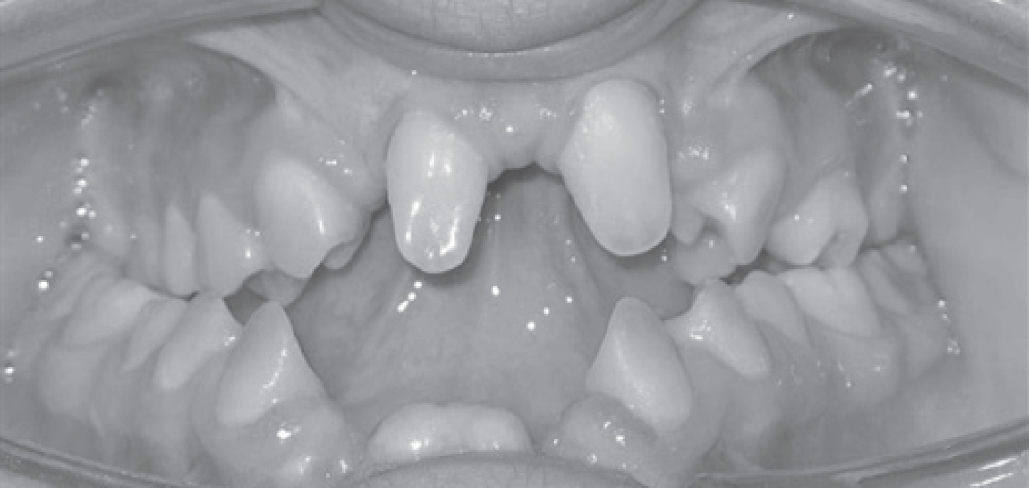 Malformed Maxillary Central Incisors