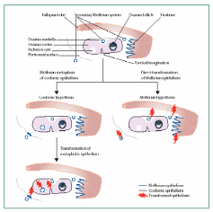  The coelomic versus Müllerian hypothesis of OEC and extra-ovarian cancers. 