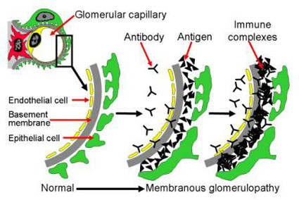 Formation of sub-epithelial immune complex deposits (adapted from “membranous nephropathy”: UNC Kidney Center.