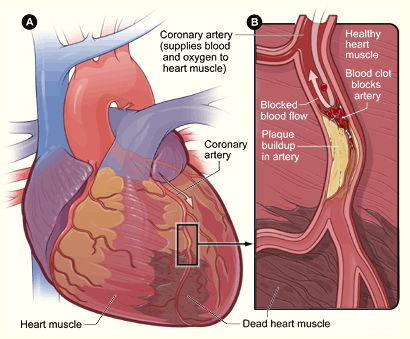 Heart with blocked artery 