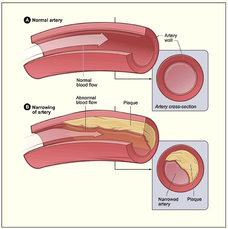 Coronary artery with plaque build-up 