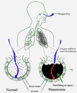 Concepts of Pneumonia Disease