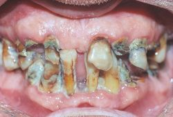 Depicts teeth affected by Dental Ankylosis.