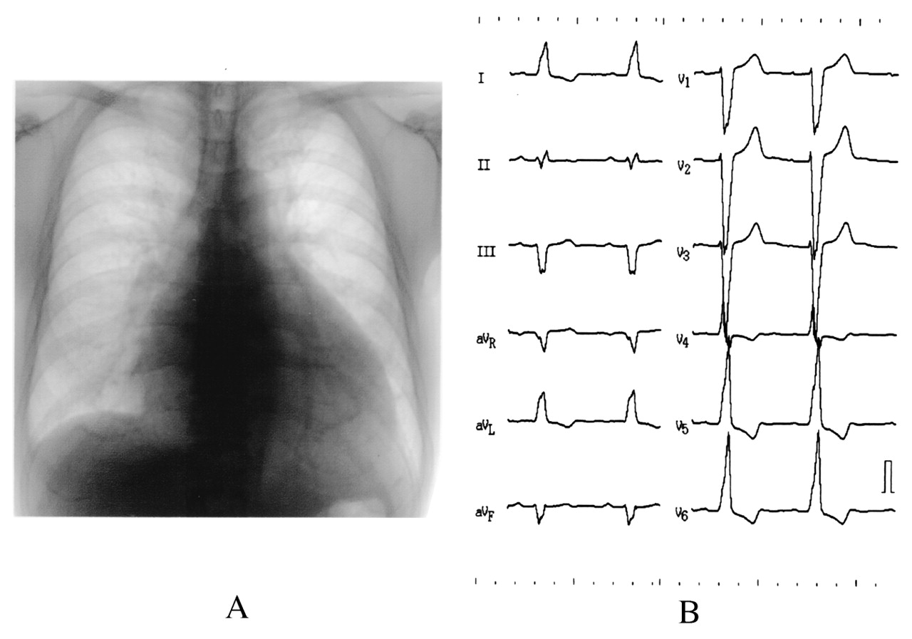 A. x ray photo indicating 66% cardiothoracic ratio cardiomegaly. B its electrocardiogram showing total block of left branch with QRS in a range of 202ms.
