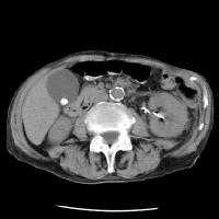 “Cholelithiasis. Non-contrast CT demonstrates a typical, laminated, calcified gallstone”