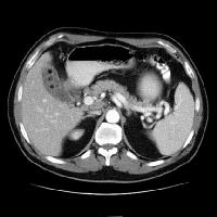 “Cholelithiasis. Contrast CT demonstrates multiple stones that faintly rim calcified and contain air” 