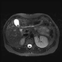 “Cholelithiasis. Typical appearance of a gallstone as a signal void-filling defect within the gallbladder on this T2 fat-saturated MRI of the abdomen”
