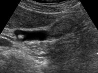 “Common bile duct stone (choledocholithiasis). The sensitivity of trans-abdominal ultrasonography for choledocholithiasis is approximately 75% in the presence of dilated ducts and 50% for non-dilated ducts” 