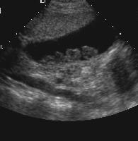 Cholelithiasis. Ultrasound image obtained with a 3-MHz transducer demonstrates pyramidal non-shadowing stones