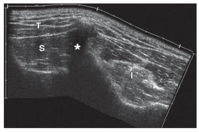 Extended field-of-view sonogram for patient with shoulder pain