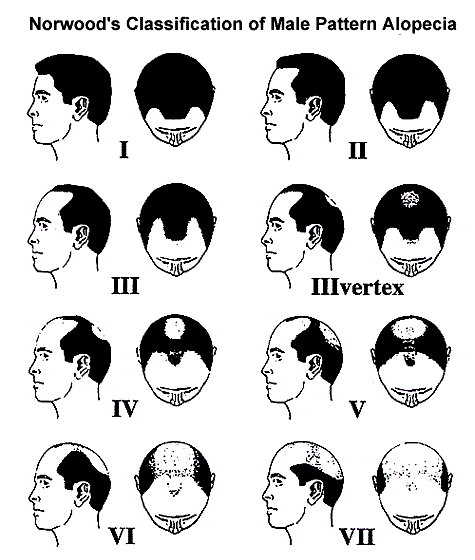 Forms of male pattern baldness