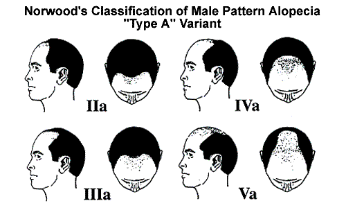 Classification of Hair Loss in Men