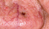 The Nose: A High Risk Area for Cancer.