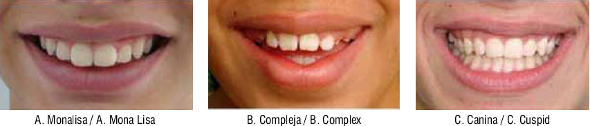 The three types of smile according to the muscles involved and the direction of the lips
