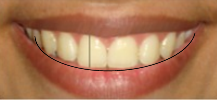 Incisors display and the smile line