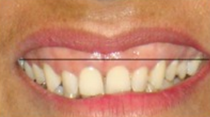 Excessive display of incisors