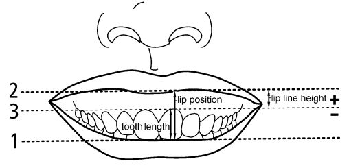 An illustration of the measurement of lip line height, tooth length and lip position