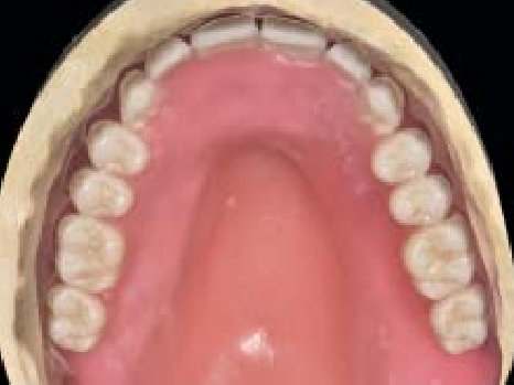 The antero-posterior curve of the occlusal plane that determines the smile arc 