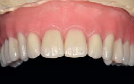 Tilting the occlusal plane upwards by 10 degrees reveals a reverse smile line