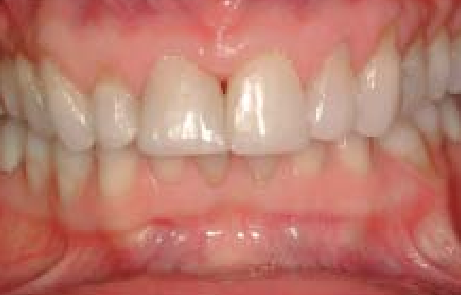 An uneven occlusal plane and short central incisors