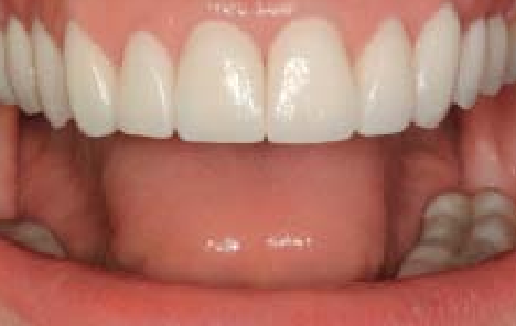 Crown lengthening using ceramic veneers leads to an even occlusal plane by extending the second premolars