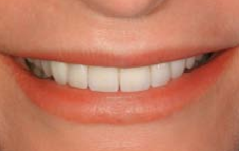 The final consonant smile line after the entire process
