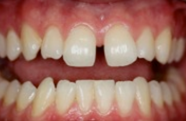 A midline diastema larger than 4 millimetres that needs orthodontic treatment 