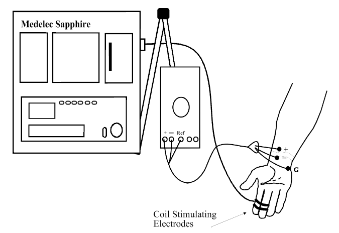 A diagram showing the set-up that was used in the measurement of sensory nerve conduction.